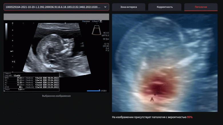 Spina Bifida_Screen_1_large.png