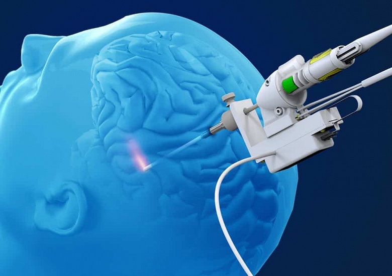 Новые исследования показывают, что воздействие лазера на мозг улучшает память