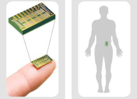 Специалисты MicroCHIPS успешно испытали на людях имплантируемый чип